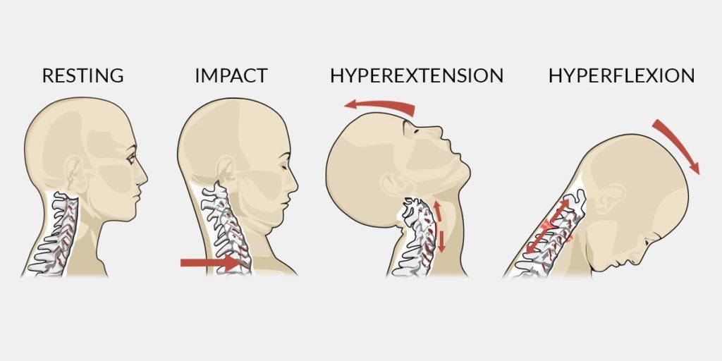 Difference Between Whiplash And A Concussion